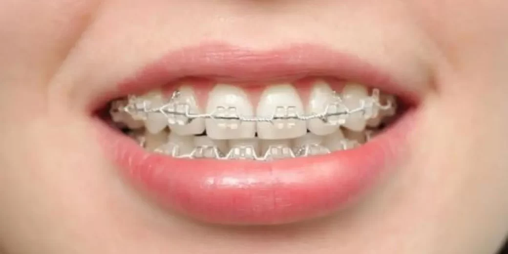 انواع تقويم الاسنان وافضلها وانسبها سعرا